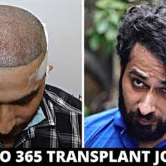 FUE Hair Transplant Timeline I Day 1 to Day 365 I Before & After | Born Creator