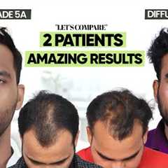 Hair Transplant in Indore | Best Results & Cost of Hair Transplant in Indore