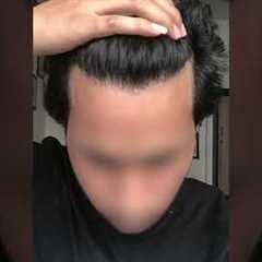 Transforming Hair, Transforming Lives! Witness the amazing results of our hair transplant procedure