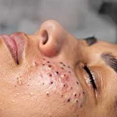 Blackhead Removal | #tweezers skincare #blackheads blackheads