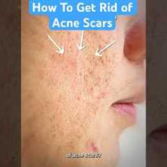 How To Get Rid of Acne Scars