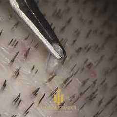 FUE Hair Transplantation Surgery (Maximum Zoom) #hairtransplant #fuemethod #hairofistanbul