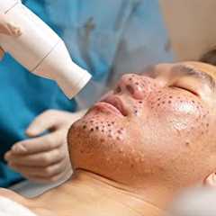 Skincare | Extreme Blackheads Removal #tweezers skincare #blackheads blackheads