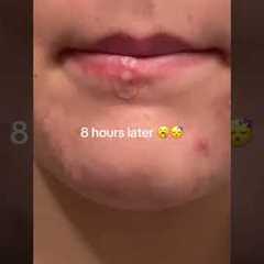 How I got rid of my pimple over night 👀 #acne #acneproneskin #skincareroutine