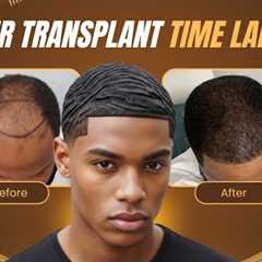 Hair Transplant Before and After: 12 Month Time Lapse Journey | Black Men Hair Loss Transformation