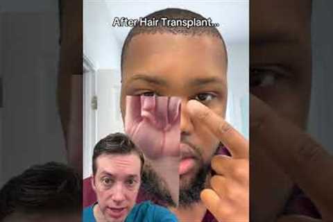 Black Hair Transplants: Why Your Hairline Matters
