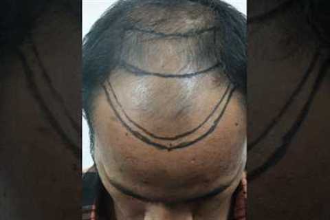 Hair Transplant Results [Before After] #hairtransplantinindia #viralvideo #shorts #hairtransplant