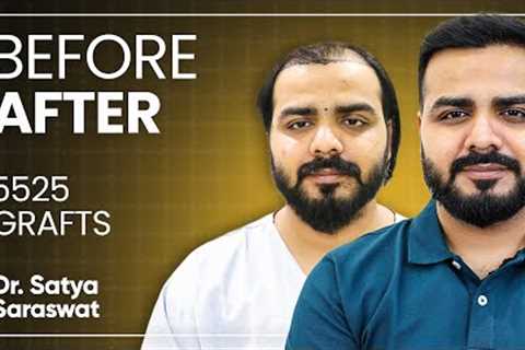 Hair Transplant in Results, Cost, Before and After Time Lapse | Best Hair Transplant India
