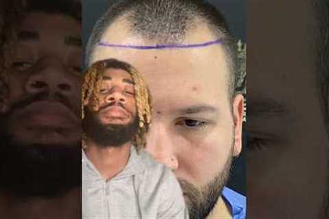 AMAZING Hair Transplant Growth #shorts