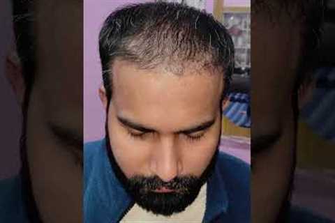 Amazing Hair Transplant Results | Latest Fue Technique #shorts #viral #hair transplant