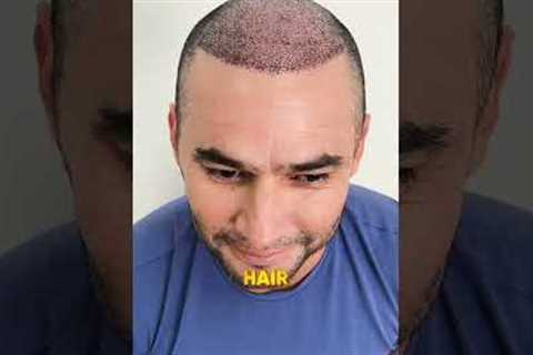 Five Months Hair Transplant Results | Latest Fue Technique #shorts #viral #hair transplant