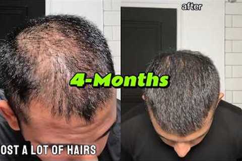 How I Reversed Hair Loss | 4 Months |  LifeOfNiravPatel