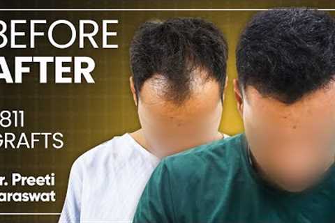 Hair Transplant Results, Cost, Before and After Time Lapse | Hair Transplant in Turkey vs India