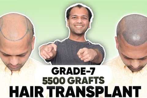 Hair Transplant in Mysore  | Best Results &amp; Cost of Hair Transplant in Mysore