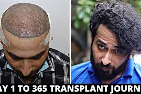 FUE Hair Transplant Timeline I Day 1 to Day 365 I Before &amp; After | Born Creator