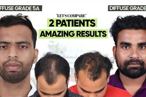 Hair Transplant in Indore | Best Results &amp; Cost of Hair Transplant in Indore