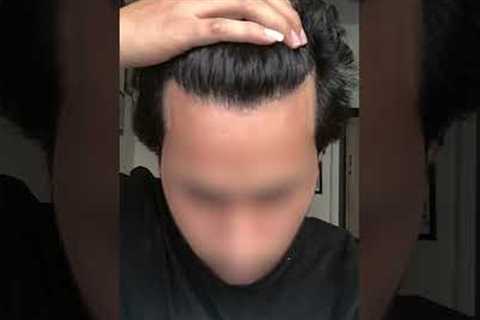 Transforming Hair, Transforming Lives! Witness the amazing results of our hair transplant procedure