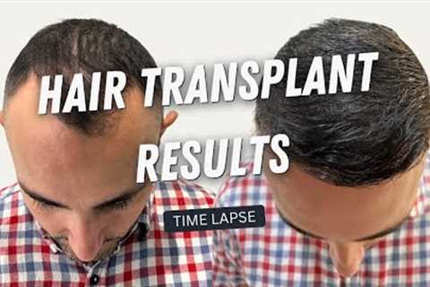 Hair Transplant Before and After | Hair Transplant Result 10 months | Hair Transplant Time lapse