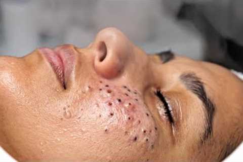 Blackhead Removal | #tweezers skincare #blackheads blackheads