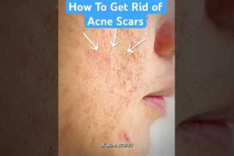 How To Get Rid of Acne Scars