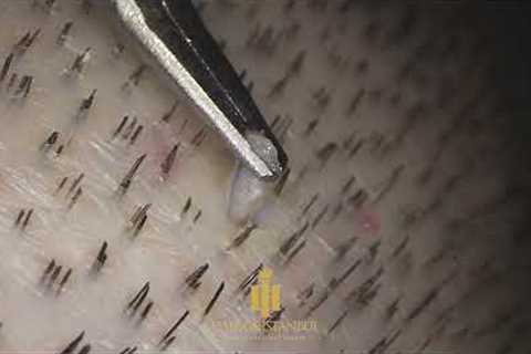 FUE Hair Transplantation Surgery (Maximum Zoom) #hairtransplant #fuemethod #hairofistanbul