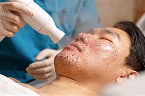 Skincare | Extreme Blackheads Removal #tweezers skincare #blackheads blackheads