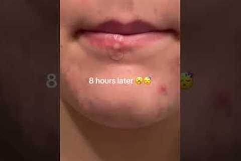 How I got rid of my pimple over night 👀 #acne #acneproneskin #skincareroutine