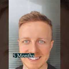 1 Year Hair Growth After Hair Transplant (Time-Lapse)