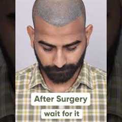 Ten Months Hair Transplant Results | Latest Fue Technique #shorts #viral #hair transplant