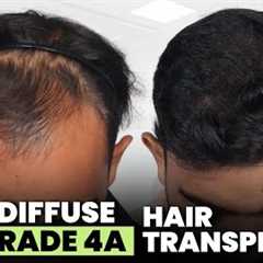 Hair Transplant in Surat (HX-AQWT) | Best Results & Cost of Hair Transplant in Surat
