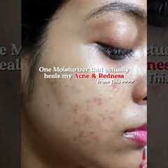 in the caption 👇🏻 Best Moisturizer for Oily Acne-prone Skin for Damaged Skin Barrier, redness,..