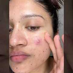 Night skincare routine for acne prone skin