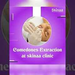 Here's A Quick Way To Solve The Comedones Extraction Problem | Viral #shorts