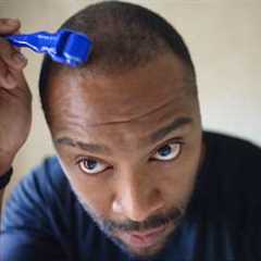 2–3 Month Hair Transplant Update: Numbness, Derma Rolling & Early Growth