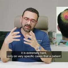 THE CROWN - Cracking the Code: Challenges of Crown Area Hair Transplants! 👑💇‍♂️