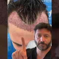 Hair restoration surgeon reacts to a bad Turkey hair transplant  #hairtransplant #hairloss
