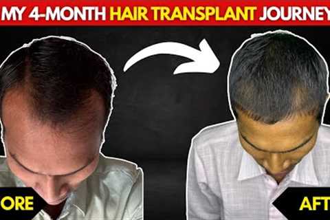 Hair Transplant 4 Months Update 🧑‍🦲➡️🧑‍🦱 | Real Results, Shedding Phase & Regrowth!