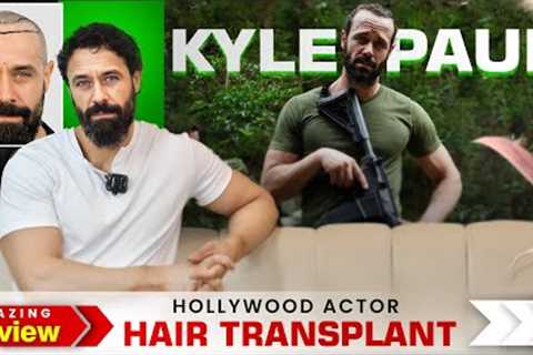 Hollywood Actor @kyle_paul Hair Transplant Journey | Amazing Hair Transplant Results in India