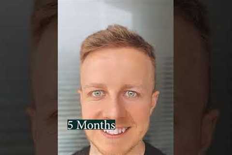 1 Year Hair Growth After Hair Transplant (Time-Lapse)