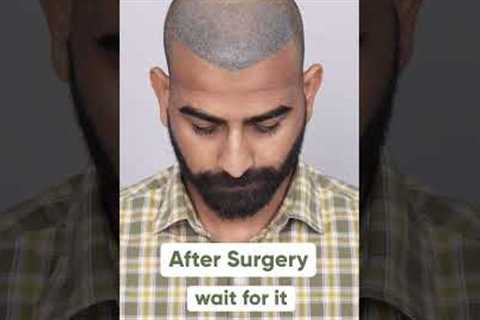 Ten Months Hair Transplant Results | Latest Fue Technique #shorts #viral #hair transplant