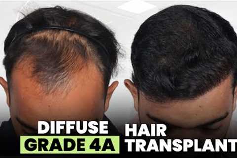 Hair Transplant in Surat (HX-AQWT) | Best Results & Cost of Hair Transplant in Surat