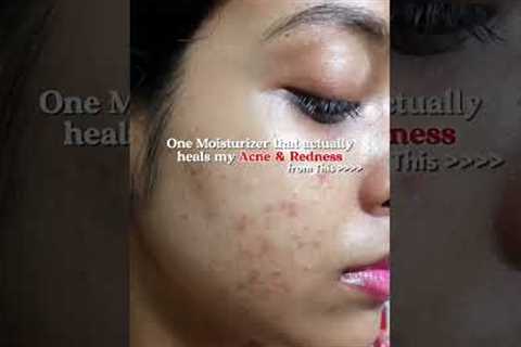 in the caption 👇🏻 Best Moisturizer for Oily Acne-prone Skin for Damaged Skin Barrier, redness,..
