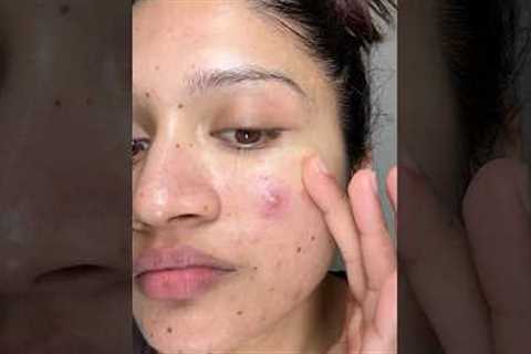 Night skincare routine for acne prone skin