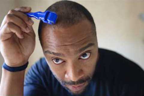 2–3 Month Hair Transplant Update: Numbness, Derma Rolling &amp; Early Growth