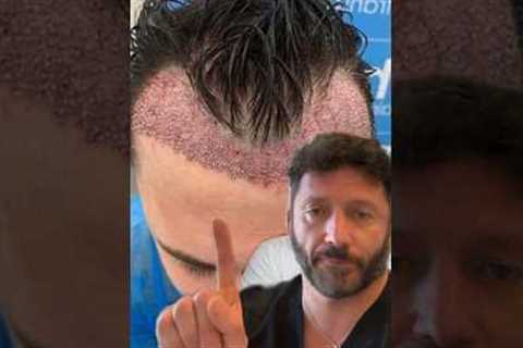 Hair restoration surgeon reacts to a bad Turkey hair transplant  #hairtransplant #hairloss