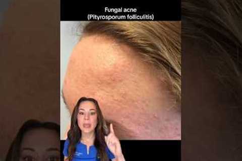 Use THIS Not THAT: Fungal Acne — From A Derm | #shorts #skincare |