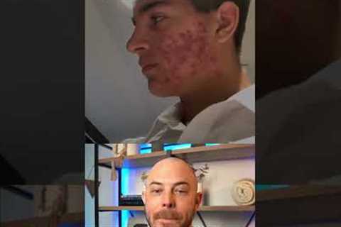 Derm reacts to unbelievable acne transformation! #dermreacts #doctorreacts #accutane