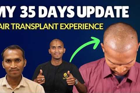 My 35 Days Hair Transplant Update! (Progress &amp; Results) 🏥