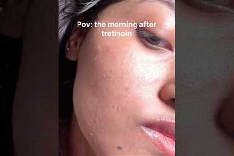 How I repair my dry irritated skin after tretinoin/retinol ✨ #acne #skincaretips #glassskin