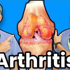 Treating Knee Arthritis Without Surgery